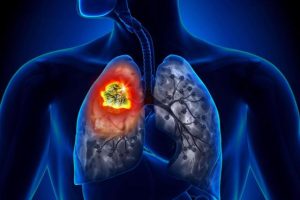 Official Cancer Diagnosis